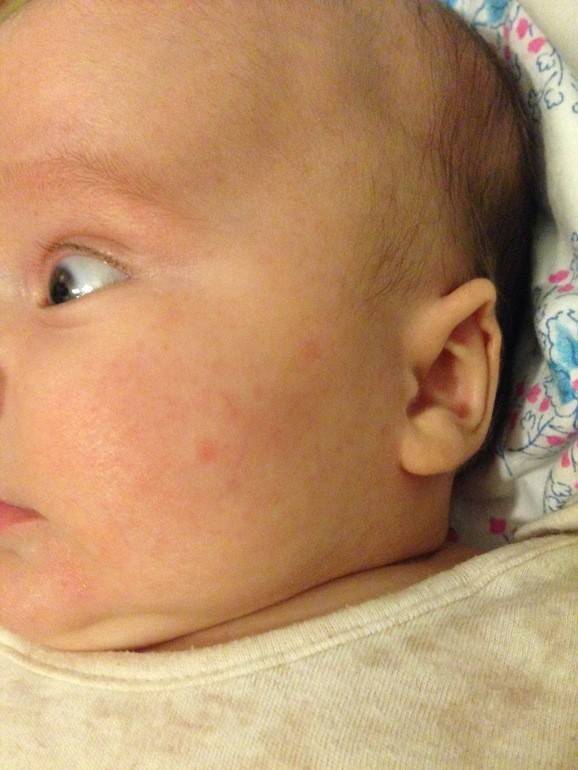 Аллергическая сыпь на коже у ребенка: виды, фото высыпаний и методы лечения