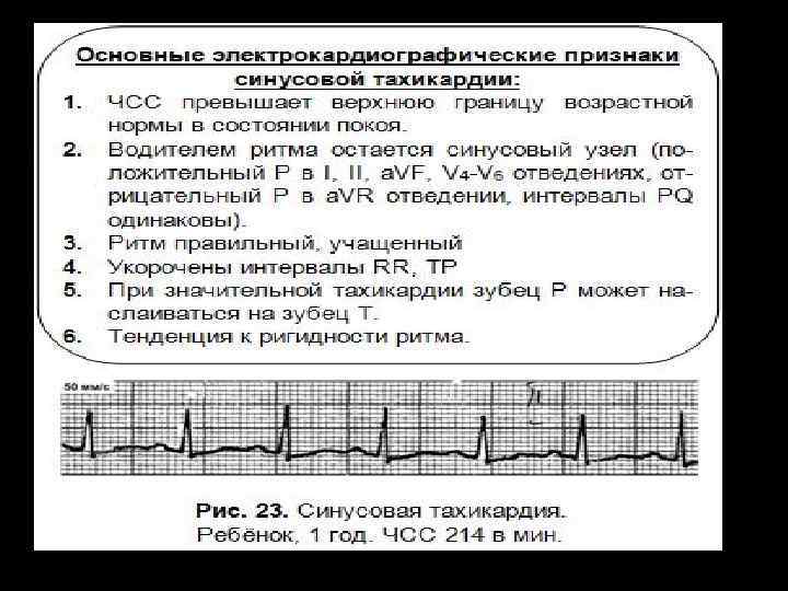 Синусовая тахикардия у ребенка: причины и симптомы патологии сердца, лечение и последствия