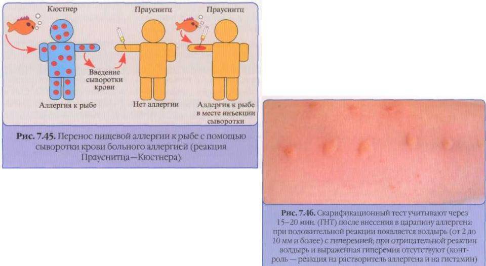 Аллергия на одуванчики у ребенка. Аллергия высыпания на коже. Кожные аллергические реакции.