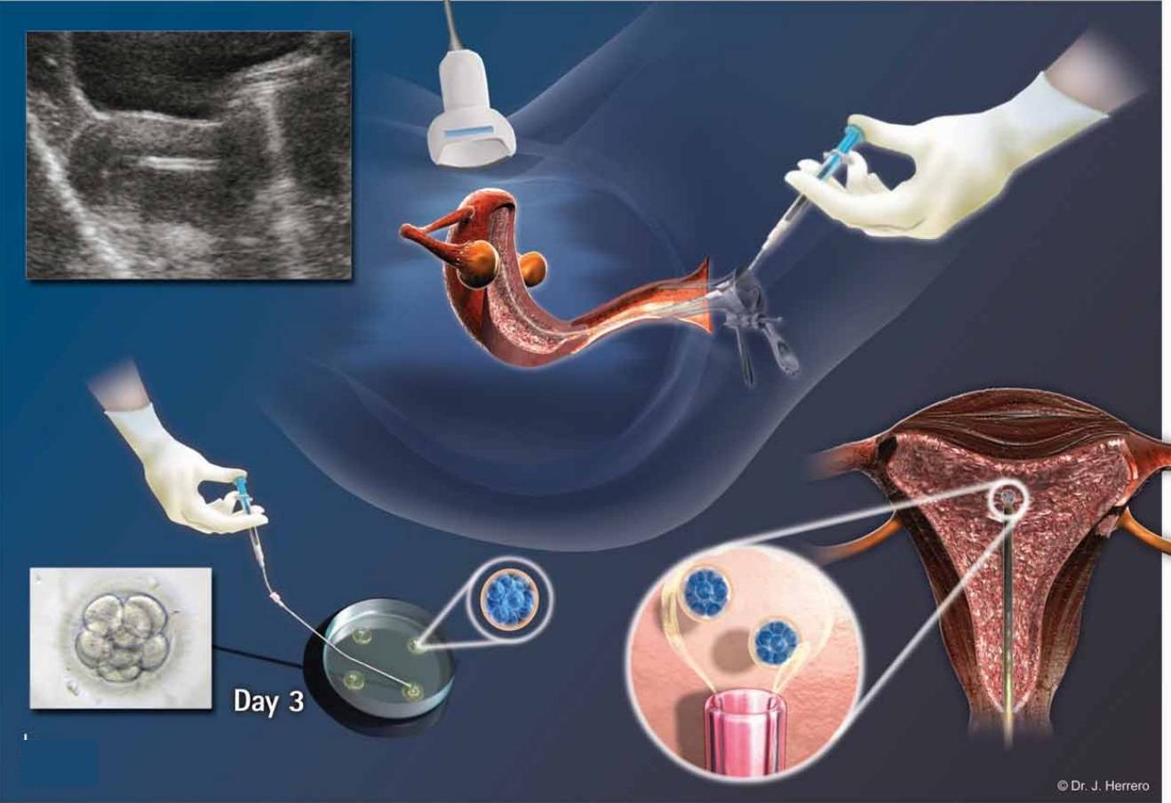 Имплантация эмбриона - симптомы и признаки. как повысить вероятность успешной имплантации эмбриона?