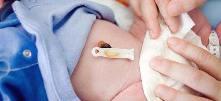 Как лечится гранулема пупка у новорожденных