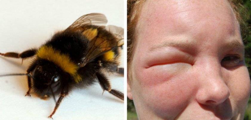 Что делать, при укусах осы или пчелы: первая помощь ребенку в домашних условиях