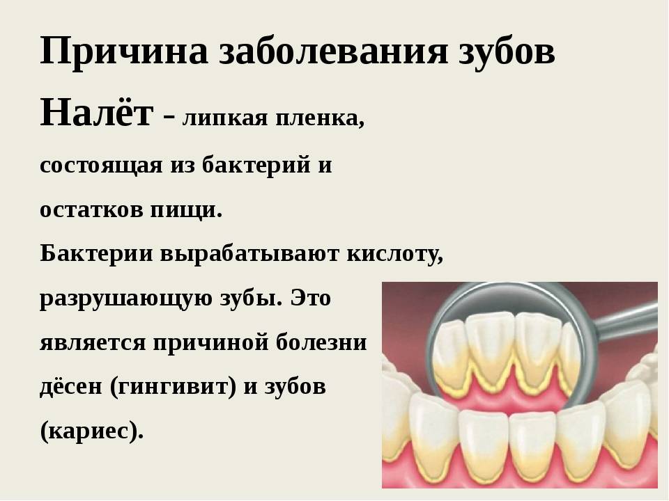 Разновидности зубного налета. причины образования и методы борьбы. — «жемчуг»— стоматология №1 в ханты-мансийске.