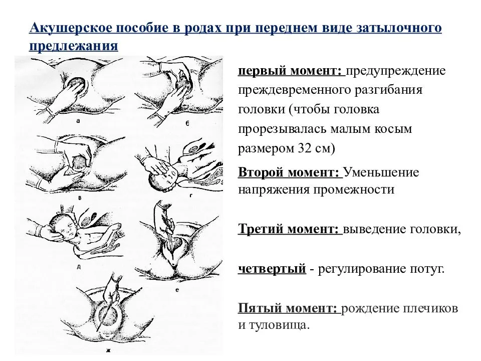 Роды при тазовом предлежании плода: естественные или посредством кесарева сечения?