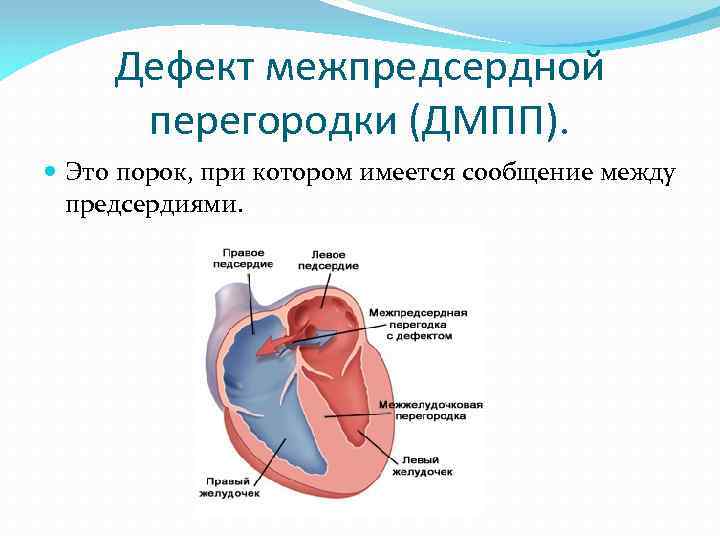 Дефект межпредсердной перегородки (дмпп) - krascor.ru