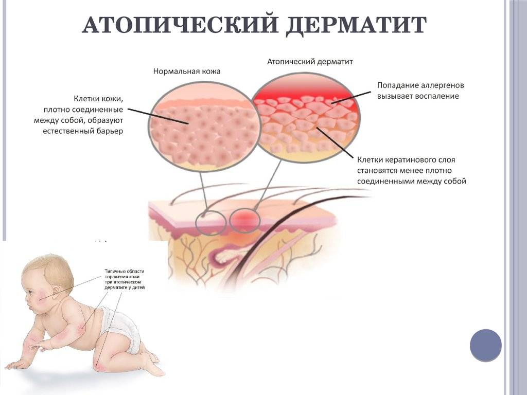 Аллергический дерматит у детей 👶: фото, симптомы и лечение в домашних условиях