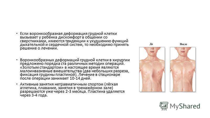 Воронкообразная деформация грудной клетки | воронкообразная грудная клетка – операция у детей и взрослых