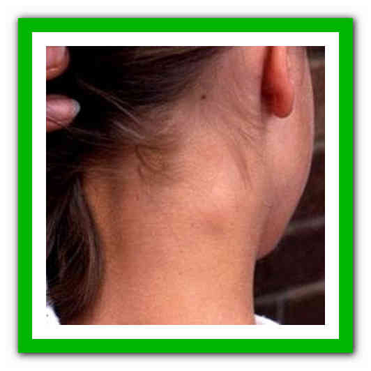 Схема лечения воспаленного лимфоузла у ребенка за ухом