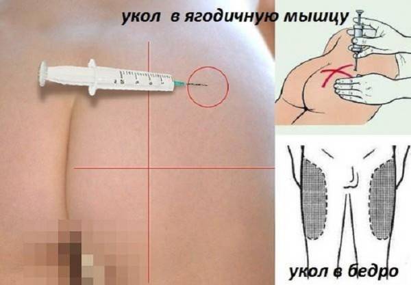 Как правильно cделать укол в ягодицу самому дома - видео, инструкция и все что нужно