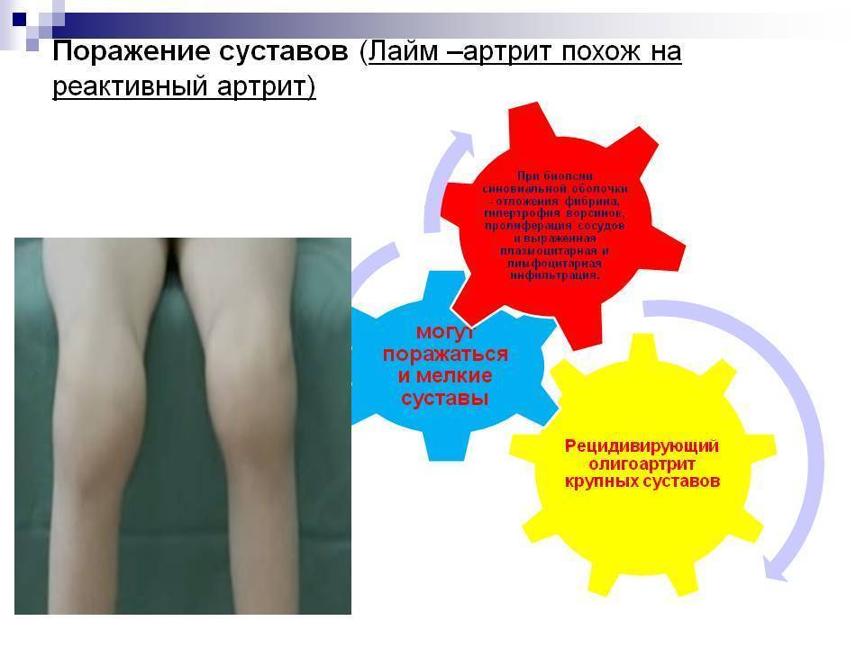 Артрит у детей - причины, симптомы и лечение воспаления суставов | medeponim.ru
