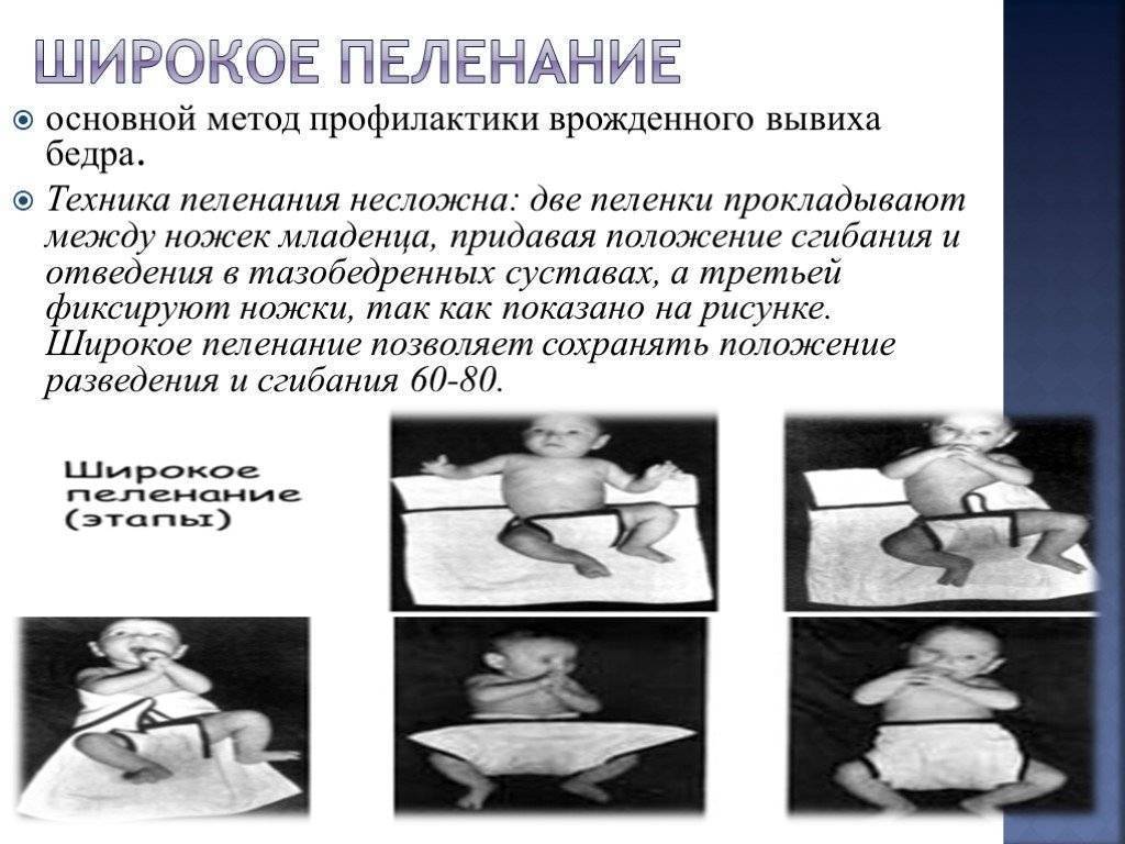 Широкое пеленание новорожденного при дисплазии тазобедренных суставов
