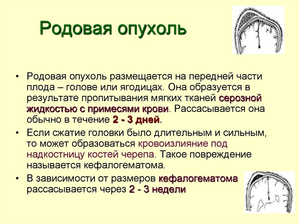 Кефалогематома у новорожденных на голове: 10 причин, лечение, 3 степени, диагностика