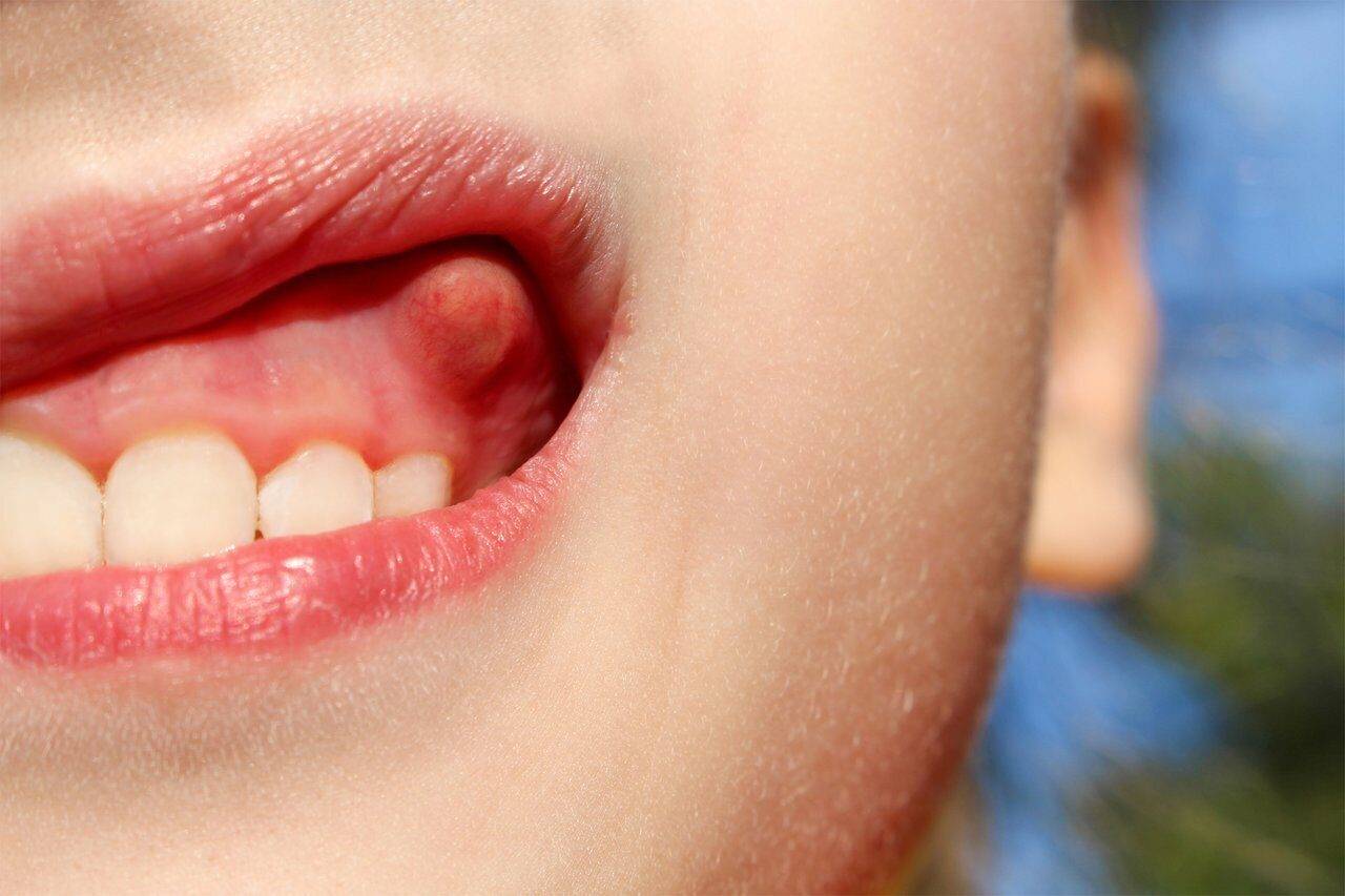 Синяя десна при прорезывании зубов у ребенка: почему появилась черная или фиолетовая гематома?