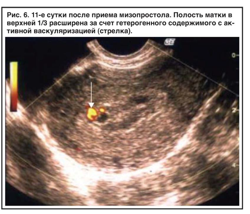 Выделения после медикаментозного аборта: сколько идут скудные коричневые, кровянистые сгустки
