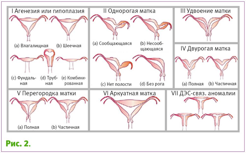 Седловидная матка и беременность: влияние на зачатие и вынашиваемость, позы для секса при патологии, хирургическое вмешательство