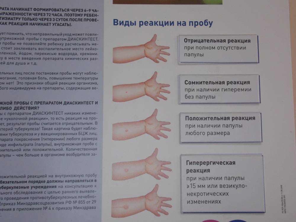 Как снять воспаление манту