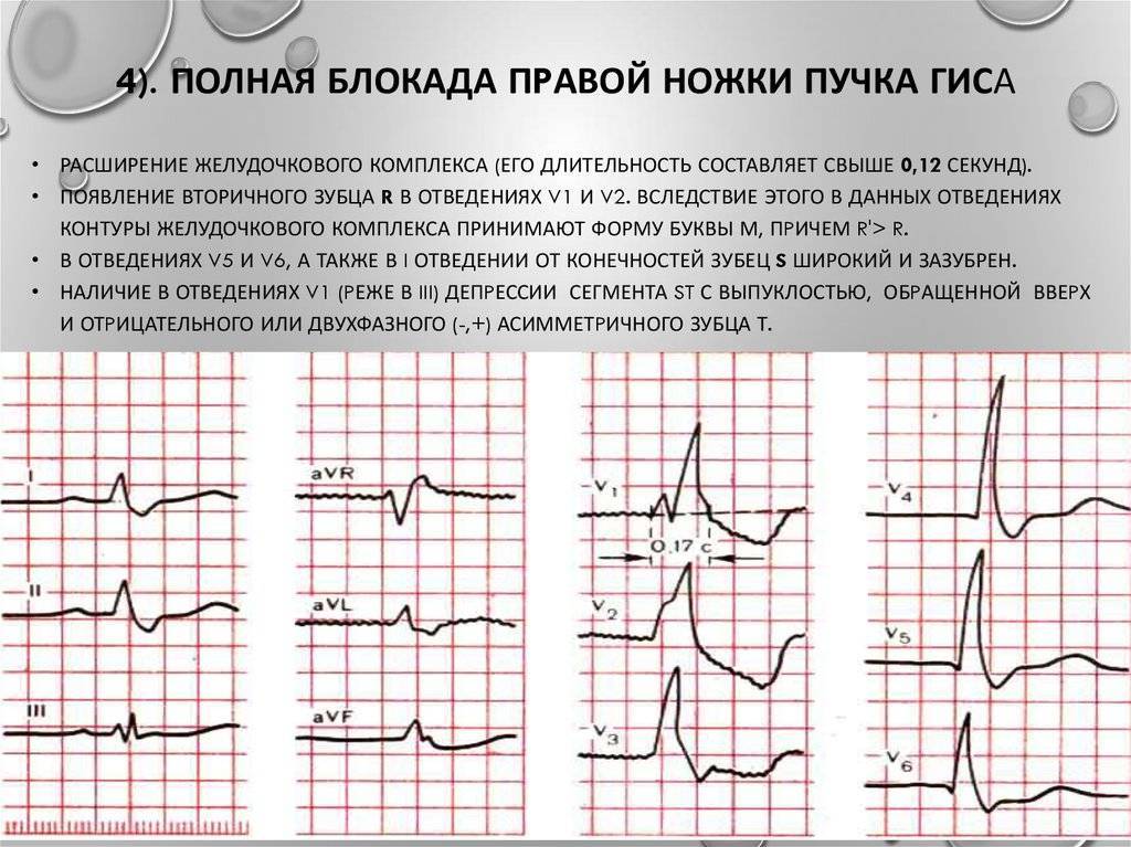 Неполная блокада правой ножки пучка гиса — есть ли повод для беспокойства?