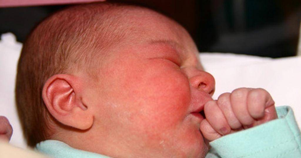 Стафилококк у новорожденных детей - признаки и лечение