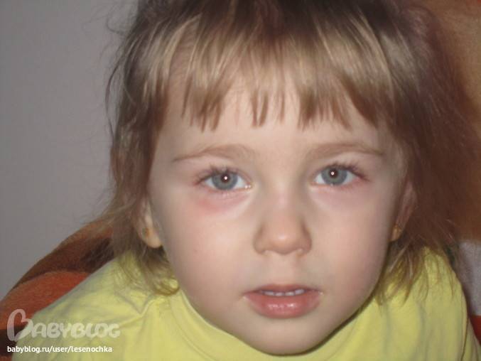 Красные круги под глазами у ребенка — почему появляются и лечение