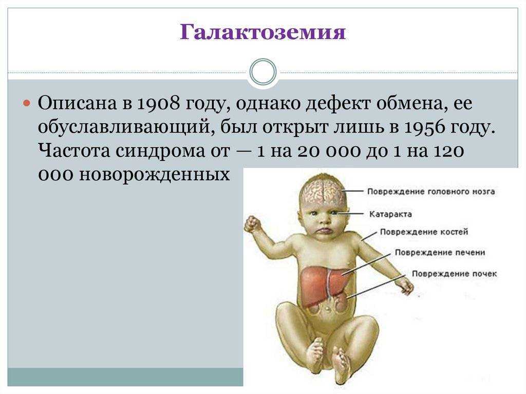 Симптомы галактоземии у новорожденных и норма фермента в крови у детей. галактоземия у новорожденных детей галактоза норма в крови у новорожденных