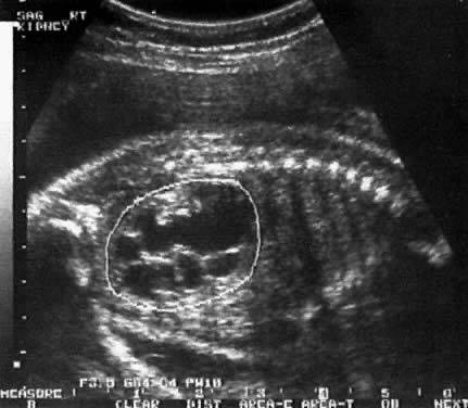 Пиелоэктазия почек у плода и новорожденного: причины расширения почечной лоханки, методы диагностики и лечения