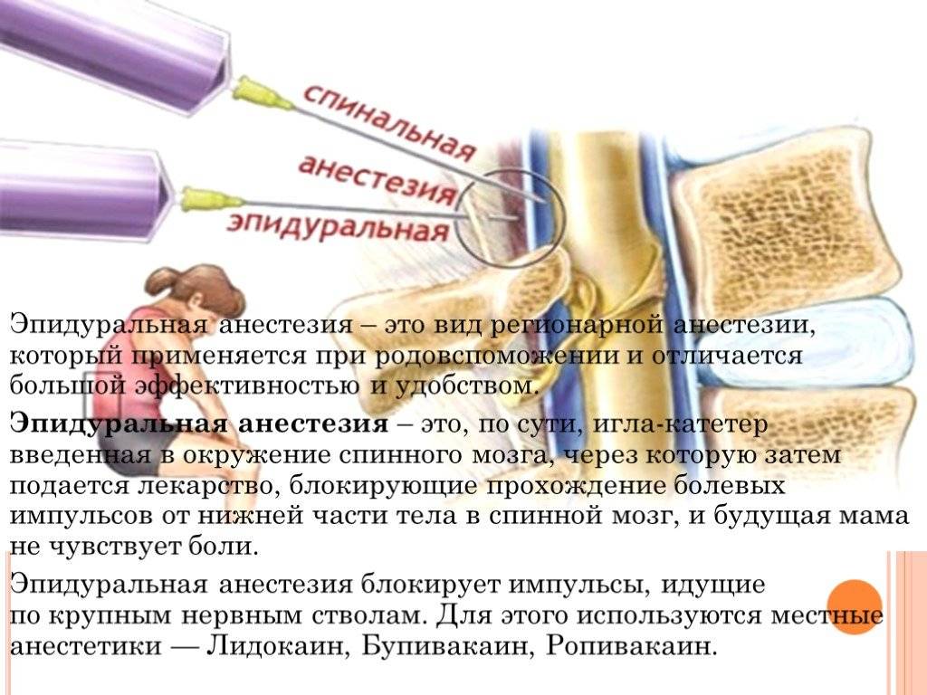 Эпидуральная анестезия при кесаревом сечении или общий наркоз - что лучше