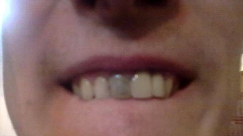Синяк на щеке после удаления зуба