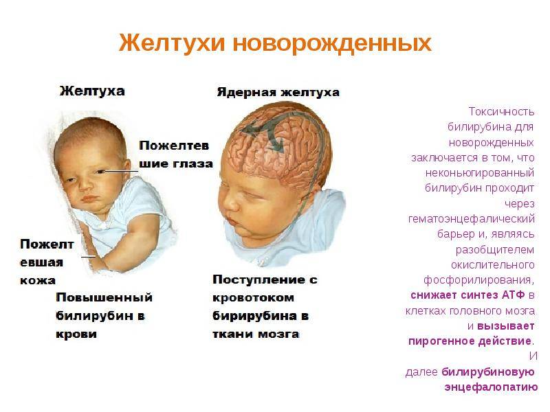Неонатальная желтуха: причины и последствия у новорожденных