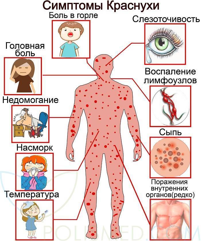 Что нужно знать родителям о том, как проходит ветрянка у детей
