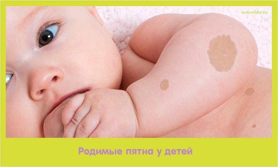 Ребенок содрал родинку - вопрос дерматологу - 03 онлайн