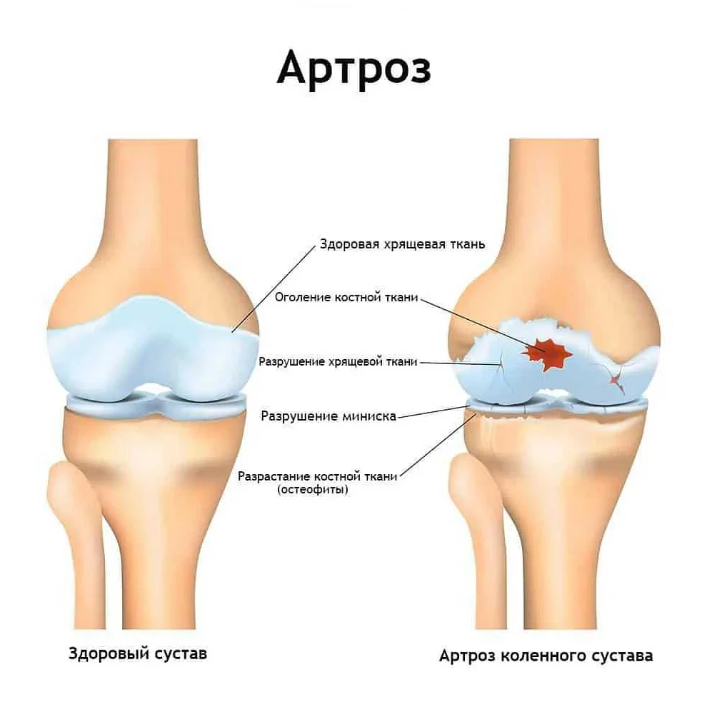 Артрит коленного сустава у детей: причины, симптомы и лечение