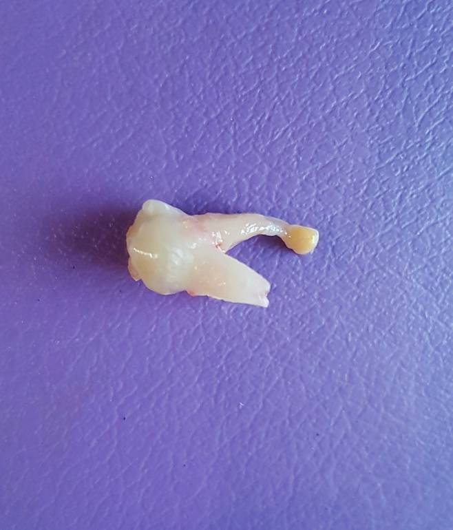 Свищ на десне у ребенка: причины, лечение, фото