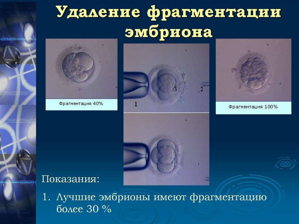 Классы эмбрионов при эко