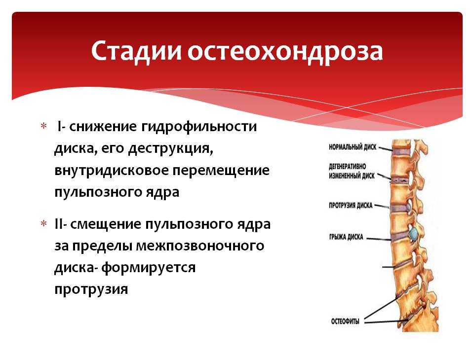 Остеохондроз при беременности: частота обострений, лечение, профилактика