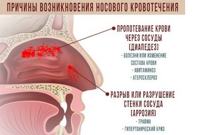 Как остановить кровь из носа: что делать при носовом кровотечении