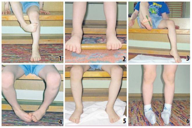 Вальгусная деформация коленных суставов: лечение вальгуса у детей (фото)