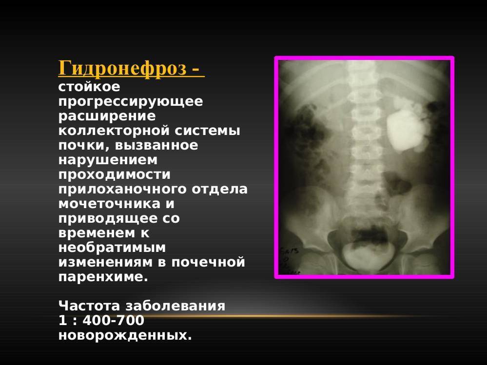 Гидронефроз почек у новорожденных: диагностика, уз-исследование, симптомы, лечение,стадии, хирургическое вмешательство,
