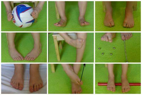Лечение вальгусной деформации коленных суставов у детей с применением лфк