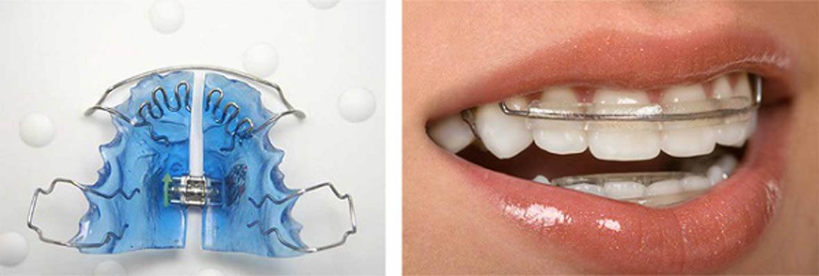 Пластинки для зубов детям