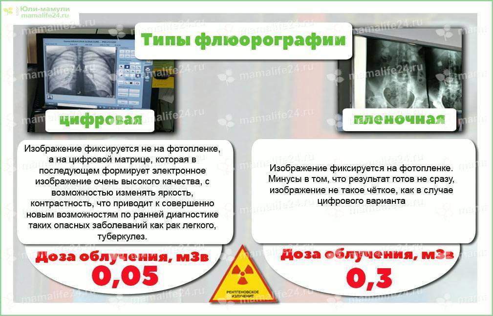 Для чего делать флюорографию мужу во время беременности жены, зачем она нужна?