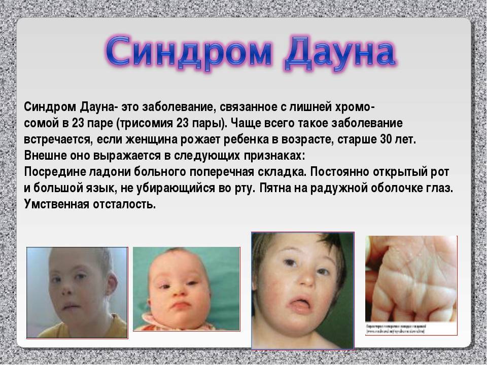 Патология синдром дауна