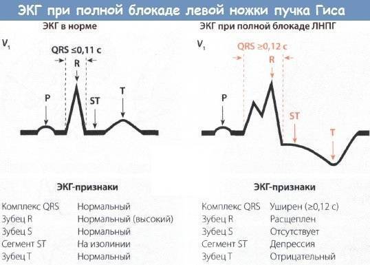 Неполная блокада правой ножки пучка гиса: причины, симптомы, диагностика, лечение