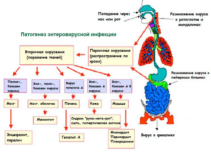 Вирус коксаки: симптомы, лечение и превентивные меры