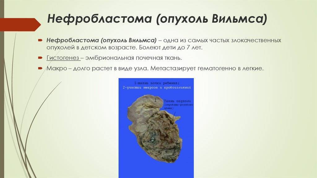 Онко вики — прогноз при опухоли вильмса