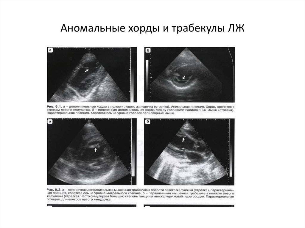 Дополнительная хорда в сердце: что это такое у ребенка, симптомы и лечение