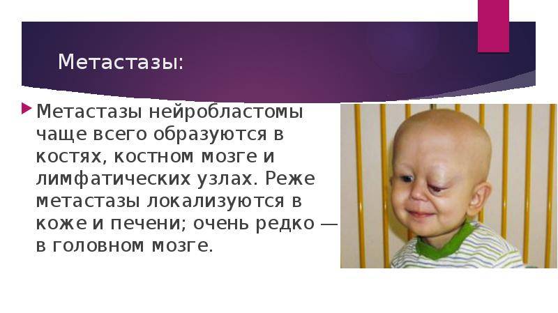 Причины и разновидности нейробластомы