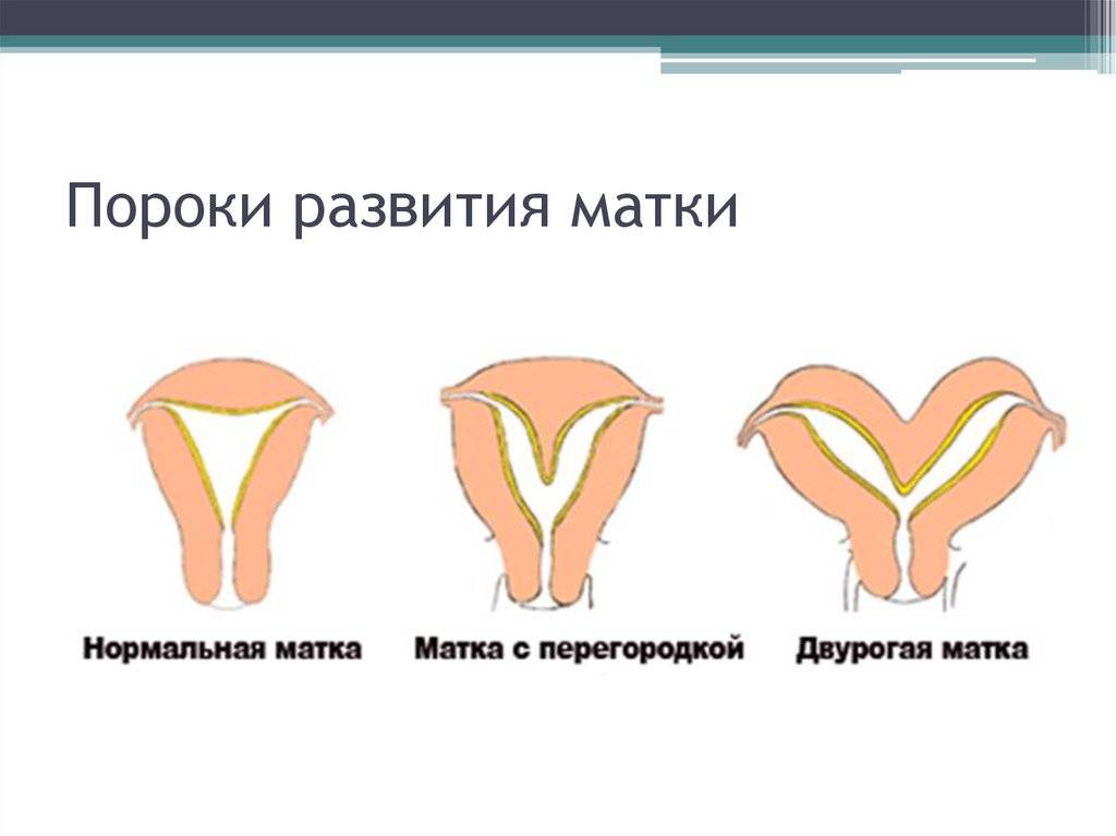 Детская матка у женщины можно ли родить. размер не главное: возможна ли беременность при детской матке? почему матка маленькая? причины