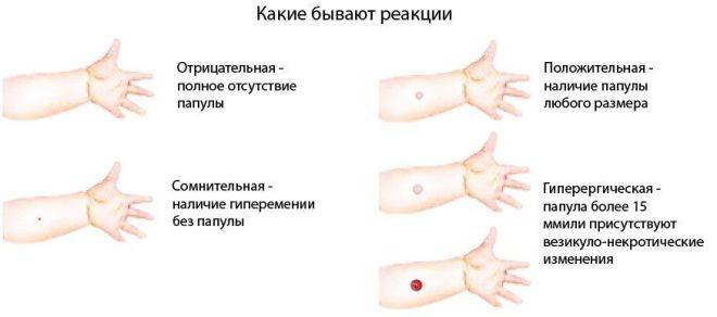 Реакция манту у детей 1 года: размеры, нормы и интерпретация результатов