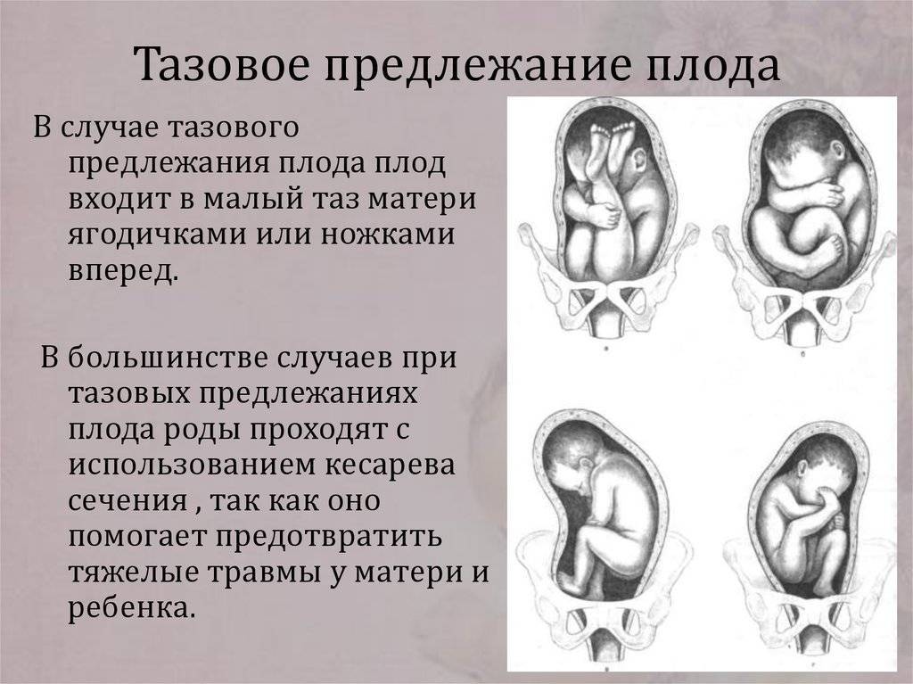 Низкая плацентация при беременности — причины и лечение — как поднять плаценту при беременности — центр гинекологии и акушерства