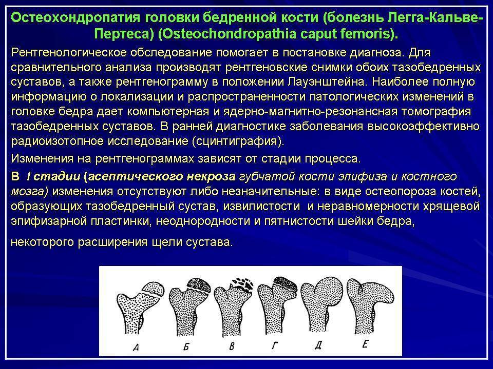 Болезнь легга-кальве-пертеса - «доктор гален» консультация ортопеда, травматолога, ревматолога. обследование. лечение. медицинские изделия.